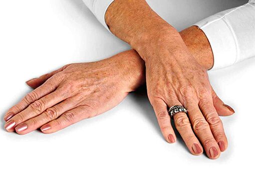 The use of hand skin rejuvenation techniques associated with age-related lesions requires the use of