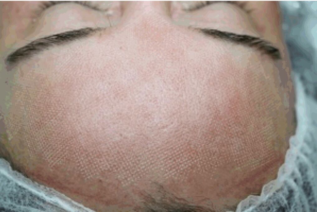 Redness and slight swelling of the skin after a fractionated laser